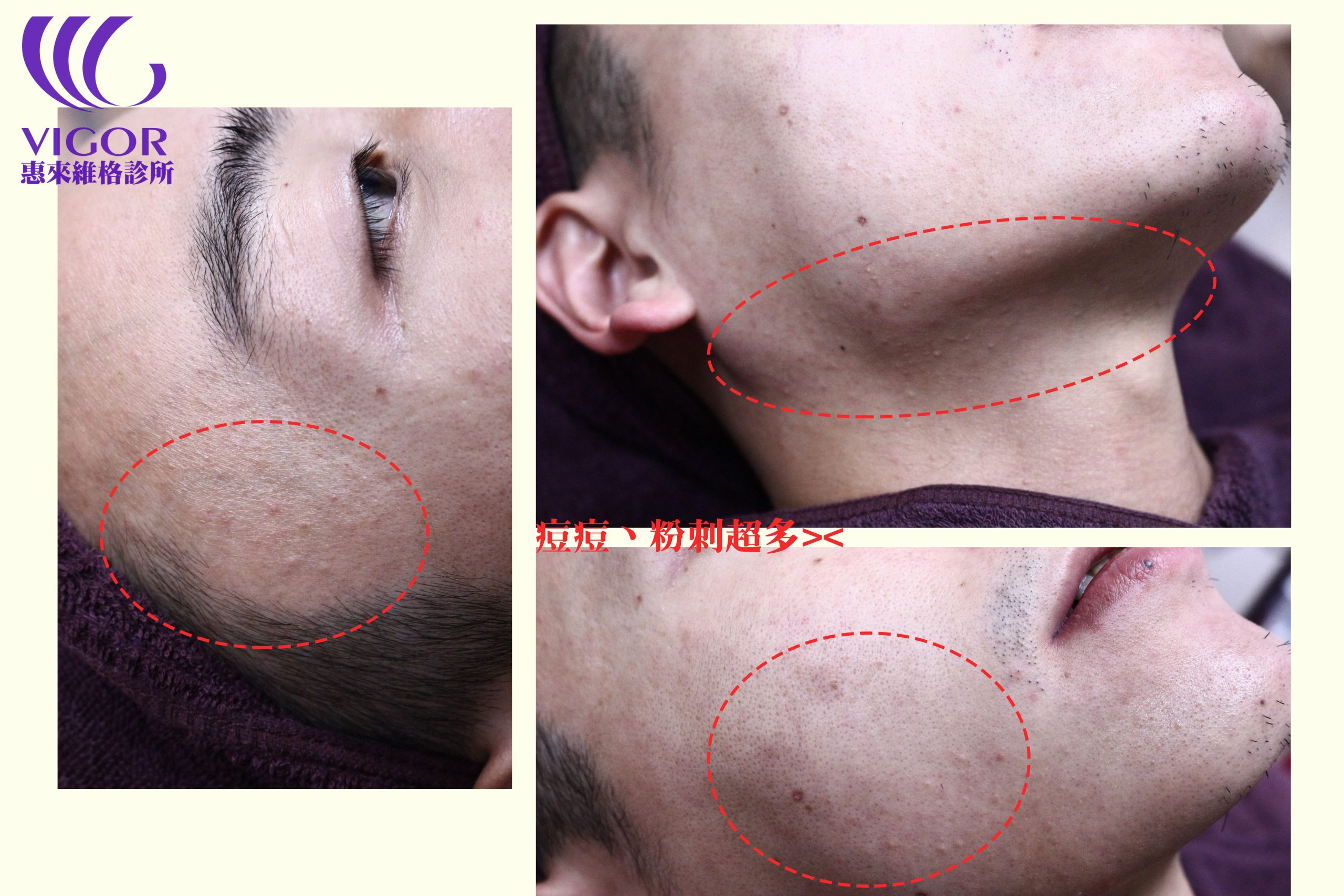 苗栗清粉刺痘痘男生做臉推薦｜美洛愃美學中心毛孔美白除毛護理