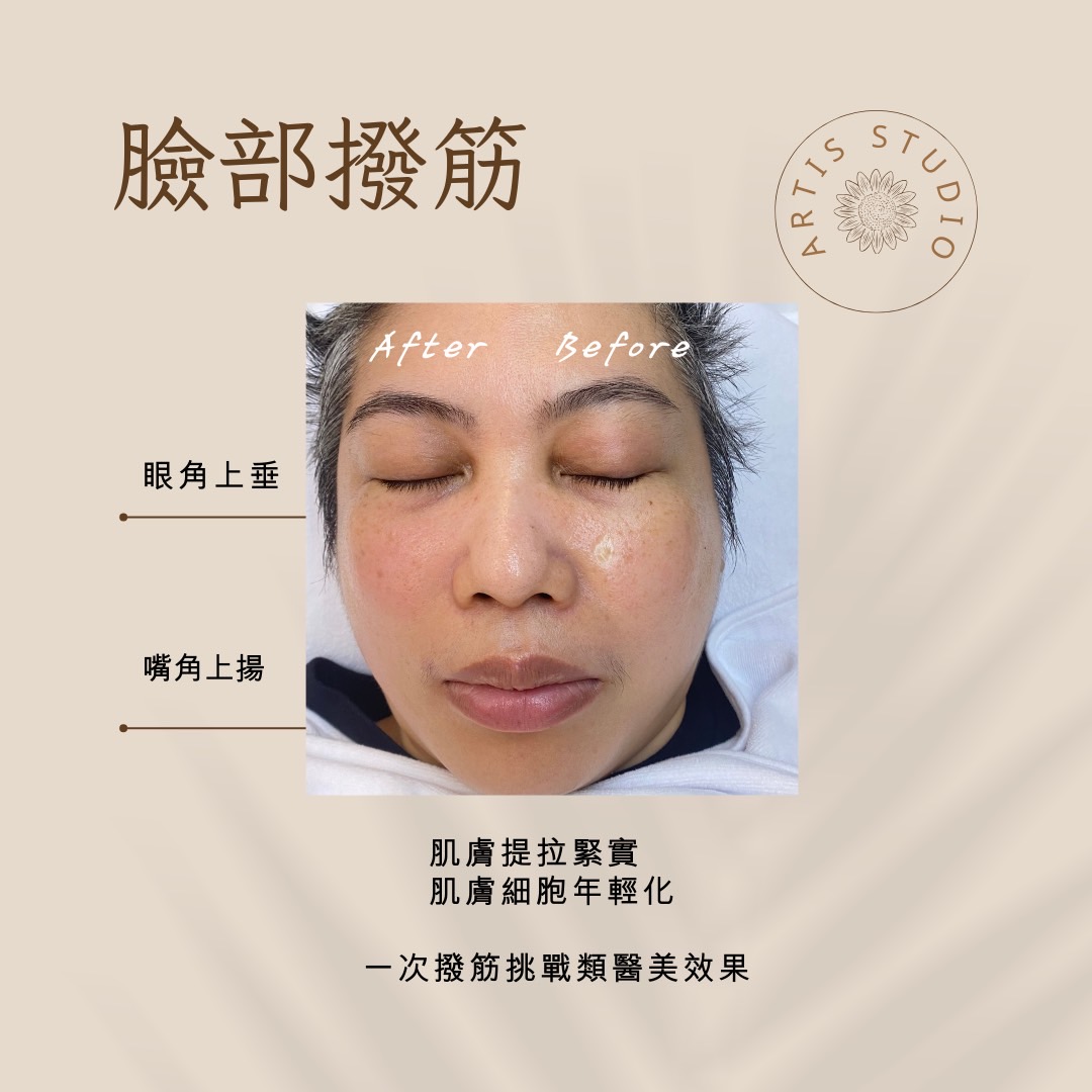 板橋亞媞斯美學苑(板橋撥筋推薦)|板橋撥筋專門店|撥筋專門店|韓式皮膚管理|板橋韓式無痛清粉刺 1 板橋撥筋推薦|亞媞斯美學苑|韓式皮膚管理|無痛清粉刺|板橋撥筋專門店